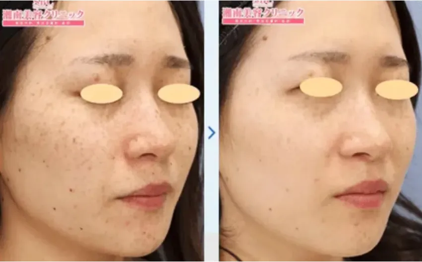 京都でピコトーニングが安いおすすめの湘南美容クリニック 症例写真