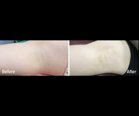 SBCのミラドライの症例