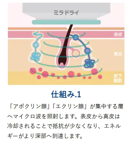 ミラドライが安いおすすめのクリニック 湘南美容クリニックの施術方法