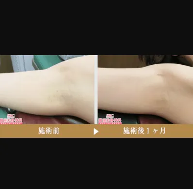 SBCのミラドライの症例