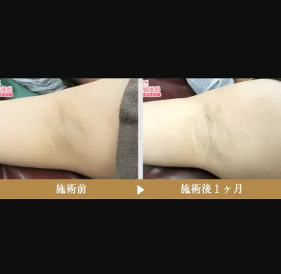 SBCのミラドライの症例