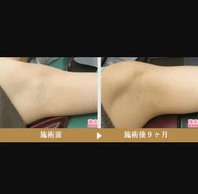 SBCのミラドライの症例