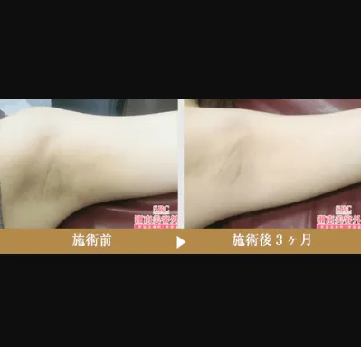 SBCのミラドライの症例