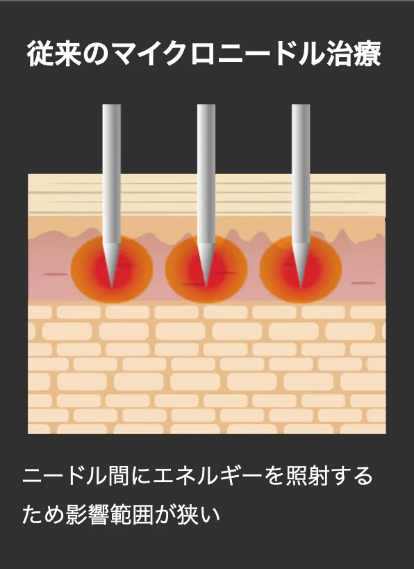 従来のマイクロニードルの仕組み