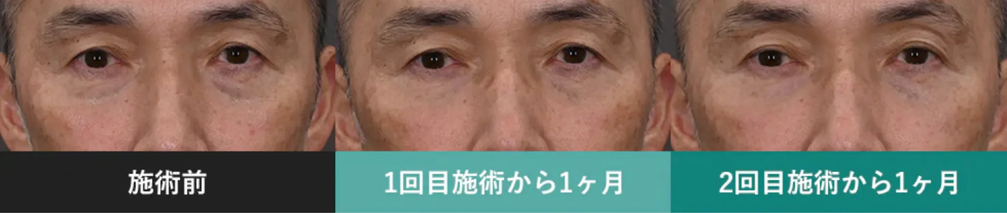 湘南美容クリニック モフィウス8 施術後の変化