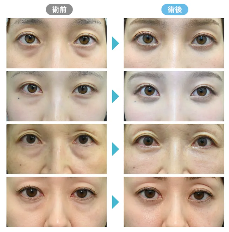 効果を期待できるモフィウス8が受けられる湘南美容クリニックの症例②