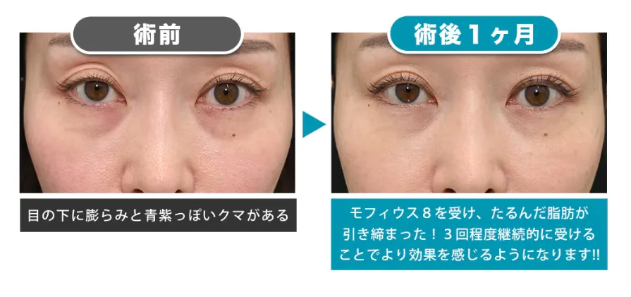 効果を期待できるモフィウス8が受けられる湘南美容クリニックの症例①