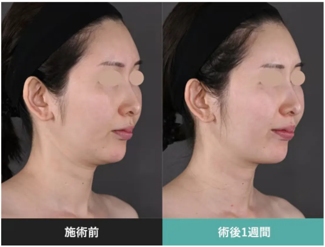 効果を期待できるモフィウス8が受けられる湘南美容クリニックの症例③