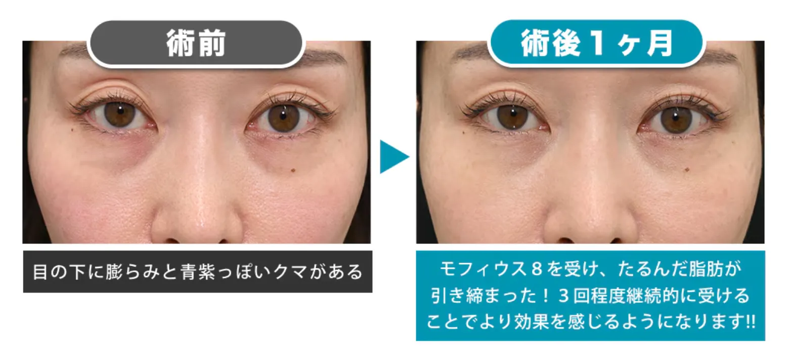 モフィウス8の値段・料金・キャンペーン面で一押しの湘南美容クリニックの症例③