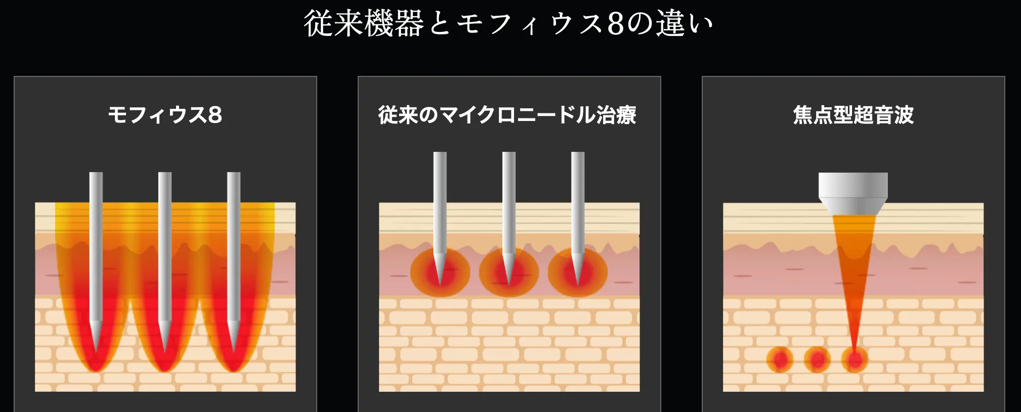 目の下やほうれい線に効果のあるモフィウス8 施術解説画像①