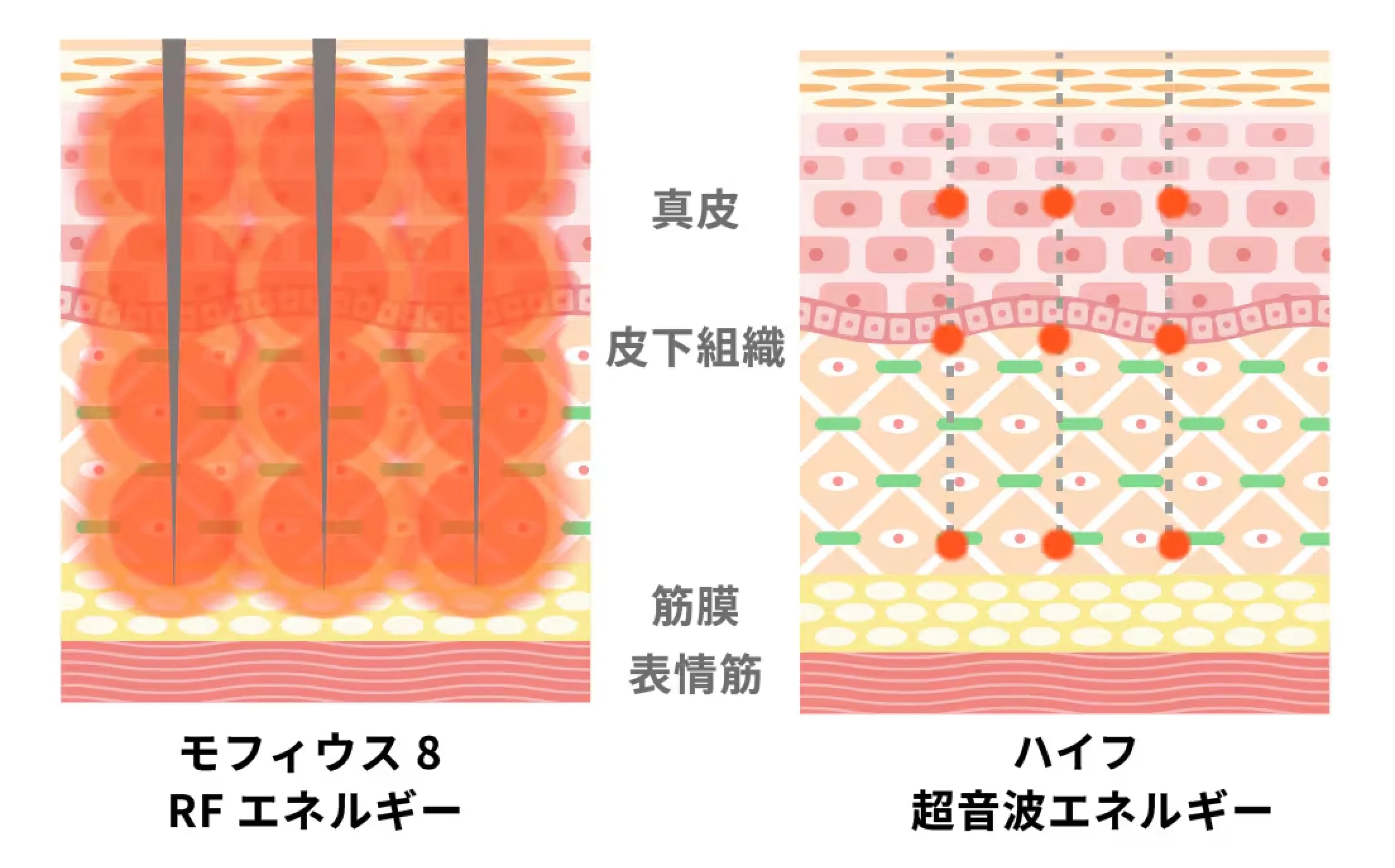 目の下やほうれい線に効果のあるモフィウス8 施術解説画像②