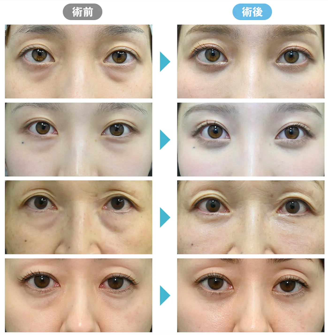 目の下やほうれい線に効果のあるモフィウス8 症例写真