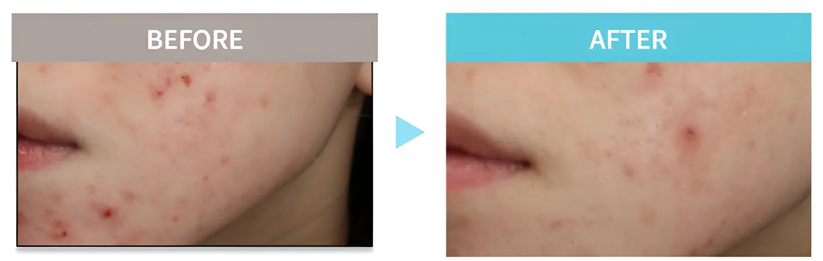 MYビューティークリニックのエリシスセンス症例写真