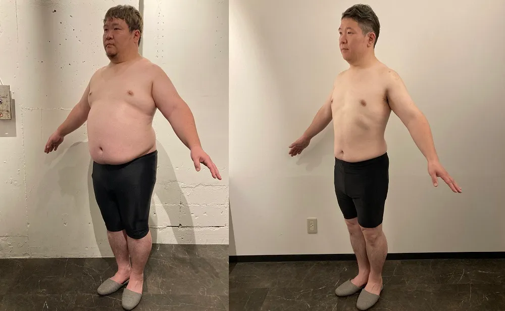 名古屋で脂肪冷却が安いおすすめクリニックであるディオクリニックの症例④