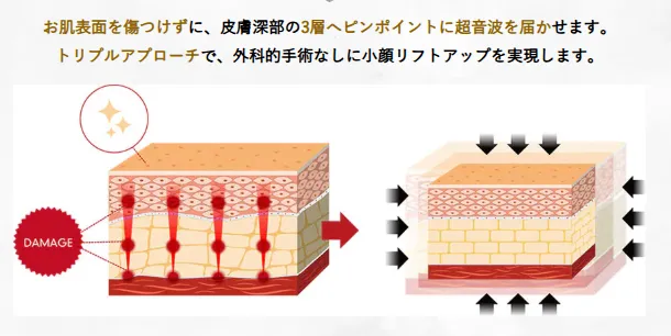 名古屋で医療ハイフの安いおすすめクリニックのトリプルアプローチ