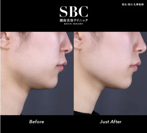 名古屋で医療ハイフの安いおすすめクリニックの症例写真