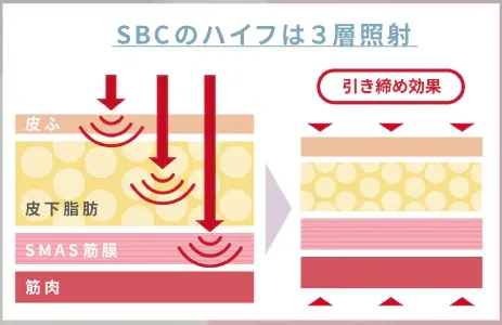 名古屋で医療ハイフの安いおすすめクリニックの照射層