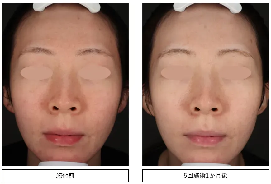 名古屋でフォトフェイシャルが受けられるおすすめの湘南美容クリニック 症例写真