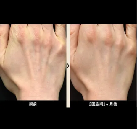 SBCのプロファイロの症例