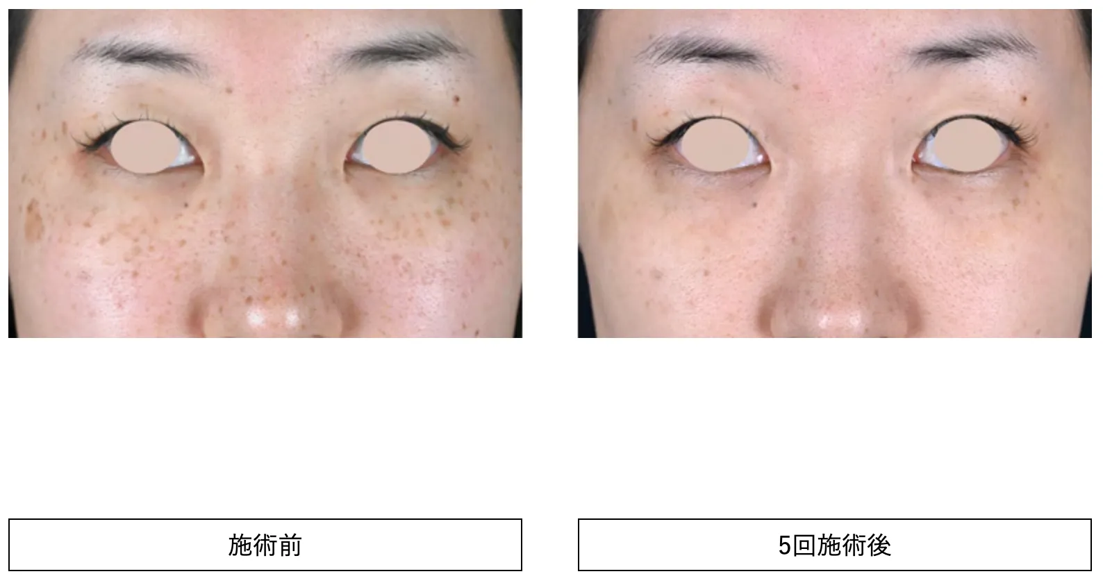 湘南美容クリニックでフォトフェイシャルの施術を受けた方の症例写真