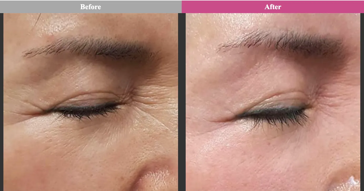 沖縄でエリシスセンスが安いおすすめクリニック 品川スキンクリニックの症例写真