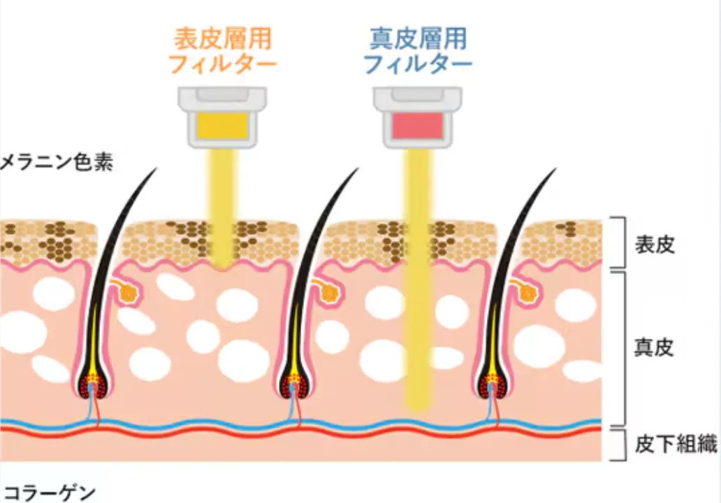 湘南美容クリニックのフォトフェイシャルの施術イメージ