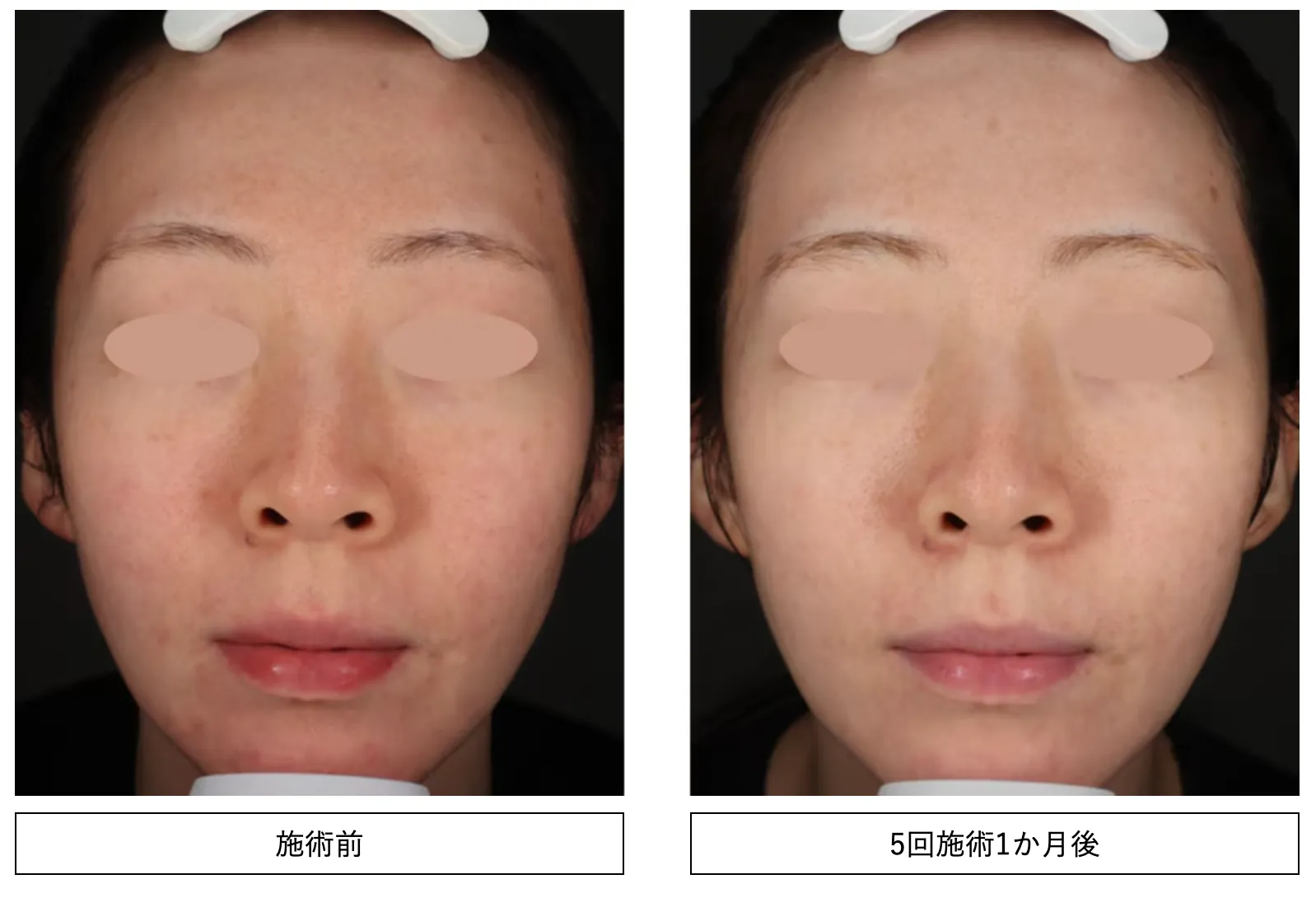 湘南美容クリニックでフォトフェイシャルの施術を受けた方の症例写真
