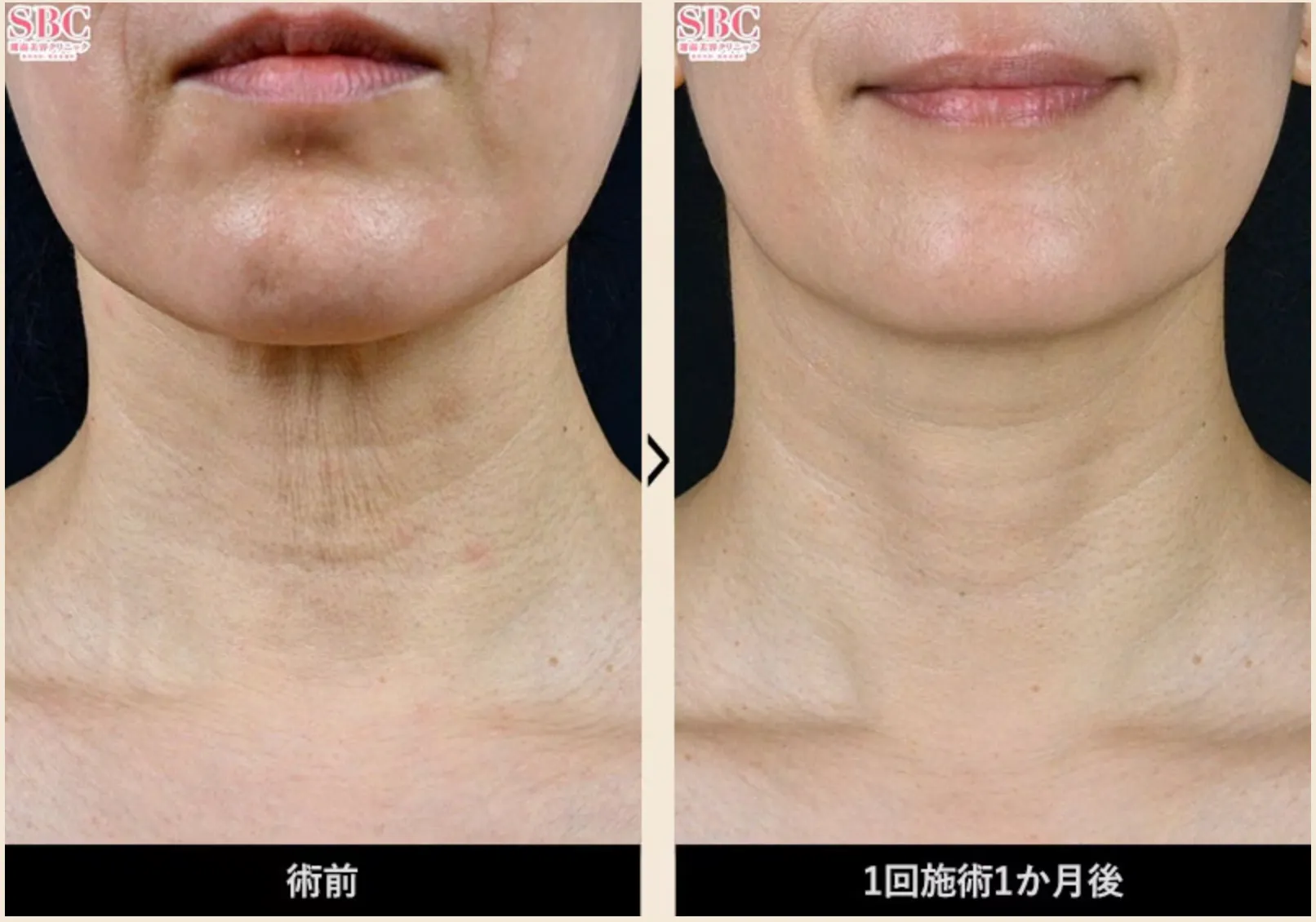 湘南美容クリニックのプロファイロを受けた方の症例写真