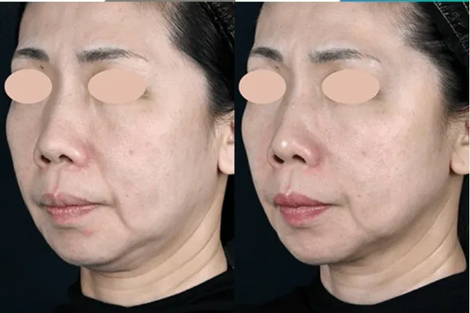 湘南美容クリニックのオンダリフトの症例1