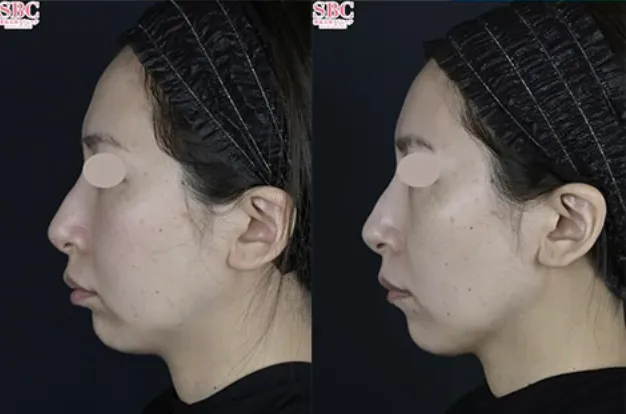 湘南美容クリニックのオンダリフトの症例2
