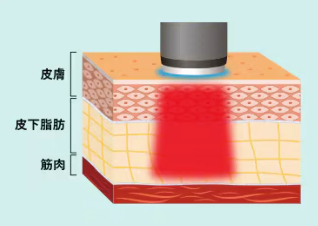 渋谷でオンダリフトが安いおすすめクリニック オンダリフトの仕組み
