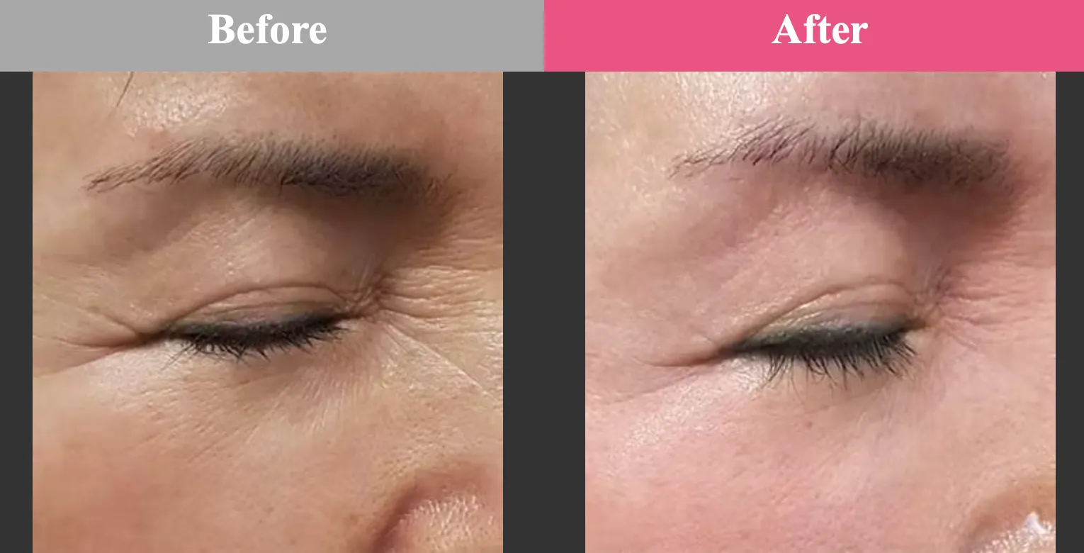 品川美容外科 目元のしわ ビフォーアフター