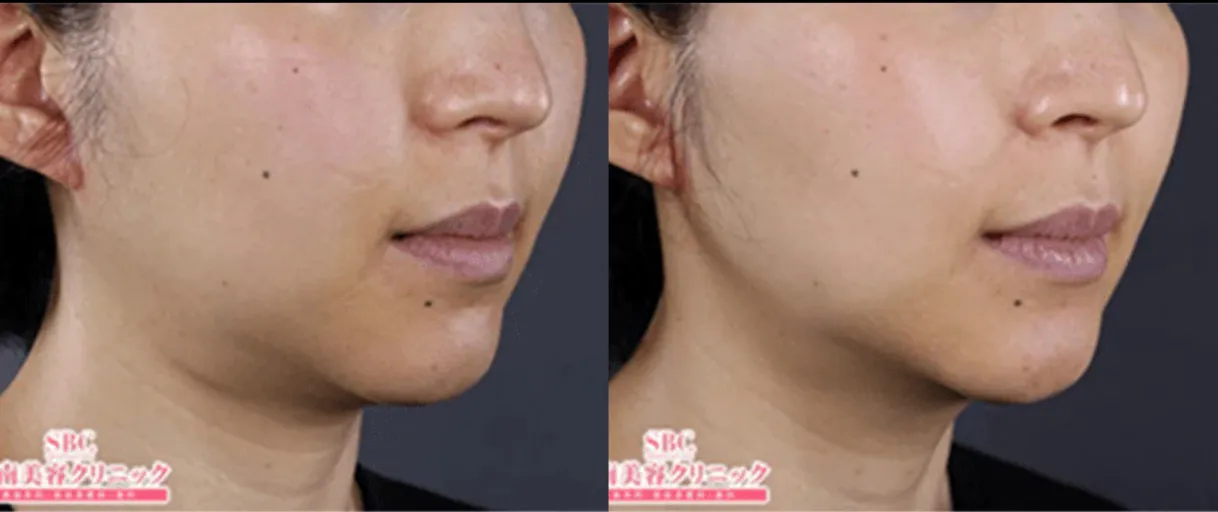 湘南美容クリニックの医療ハイフの症例1