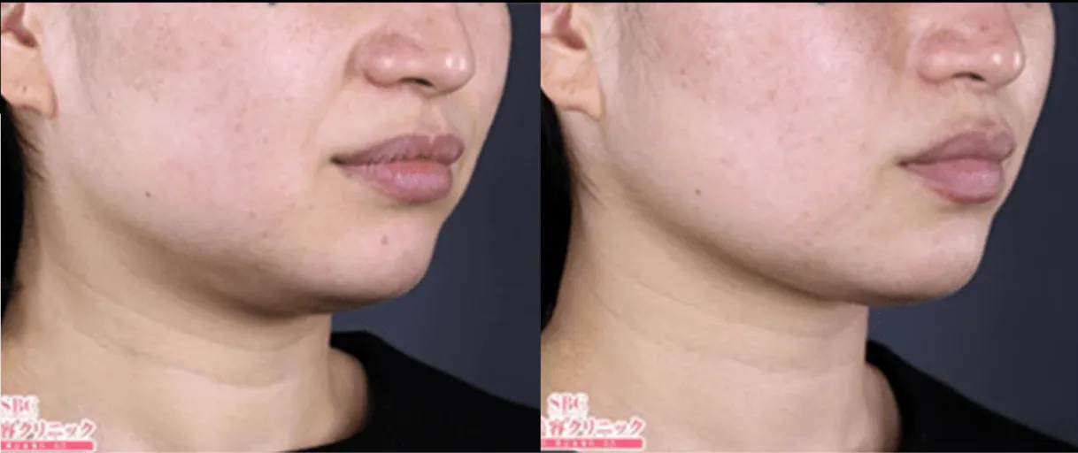 湘南美容クリニックの医療ハイフの症例2