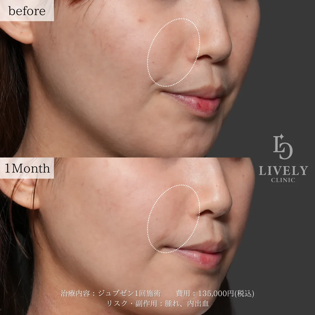 ライブリークリニックのジュブゼンの症例