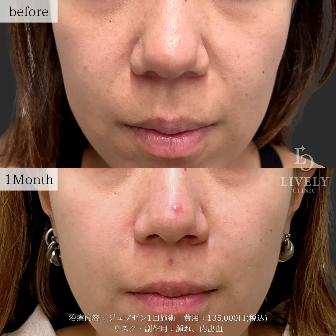 ライブリークリニックのジュブゼンの症例
