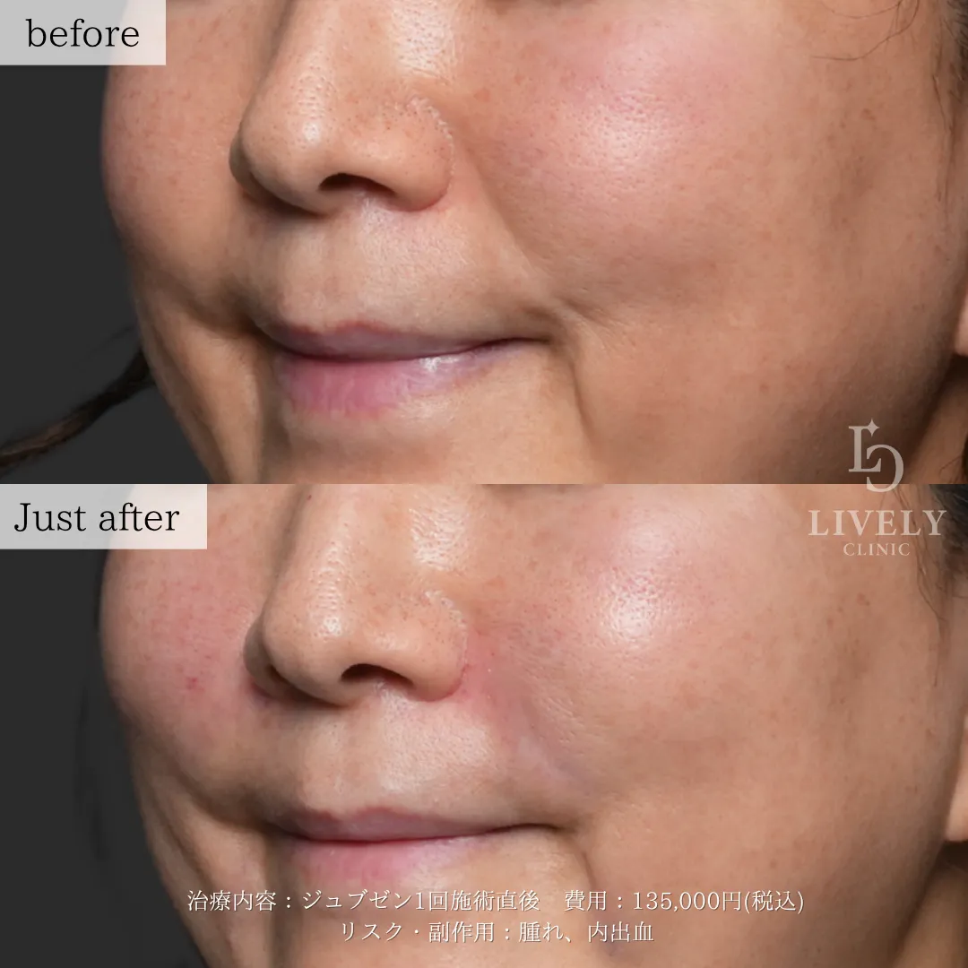 ライブリークリニックのジュブゼンの症例