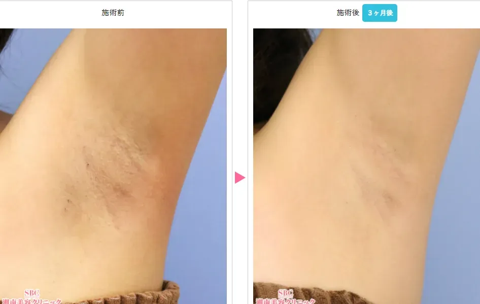 大阪で安いミラドライが受けられるおすすめの湘南美容クリニック 症例写真