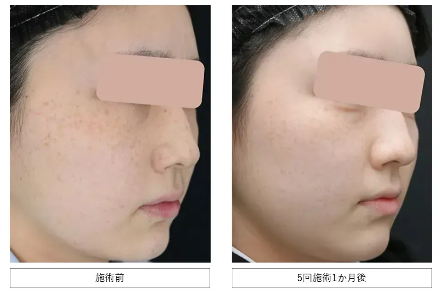 大阪でフォトフェイシャルが受けられるおすすめの湘南美容クリニック 症例写真