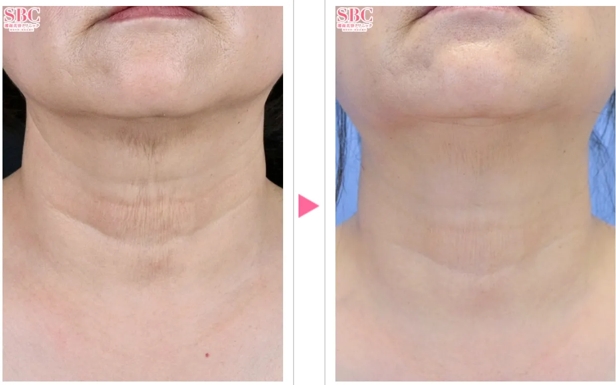 湘南美容クリニックのプロファイロの症例