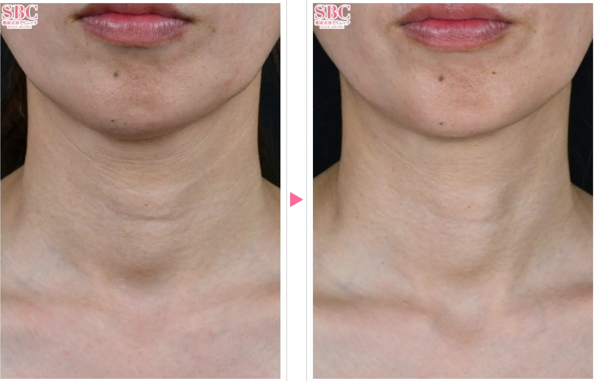 湘南美容クリニックのプロファイロの症例