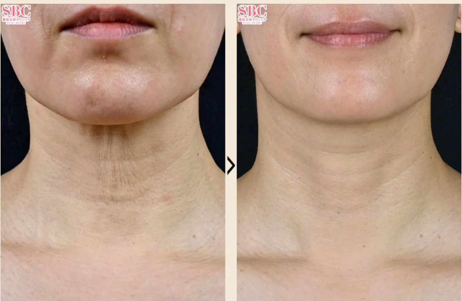 湘南美容クリニックのプロファイロの症例