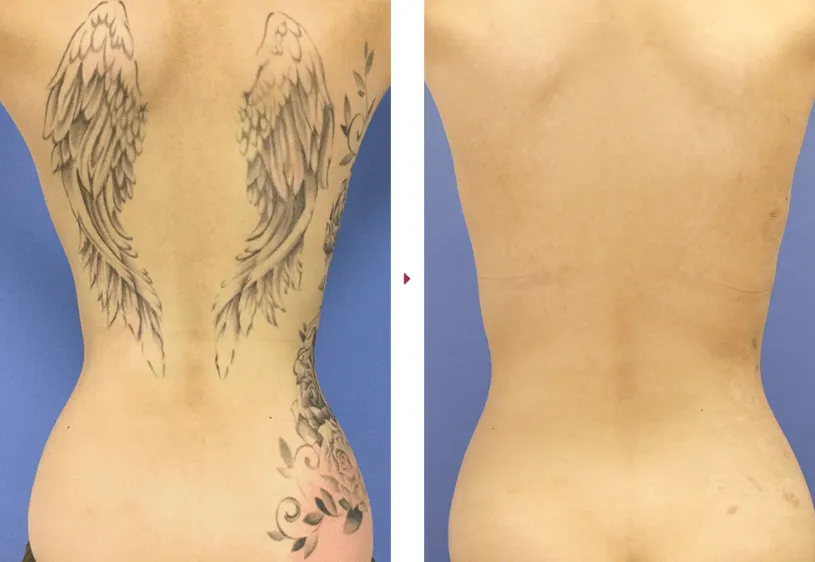 埼玉でおあすすめの安いタトゥー除去(刺青除去)SBC症例