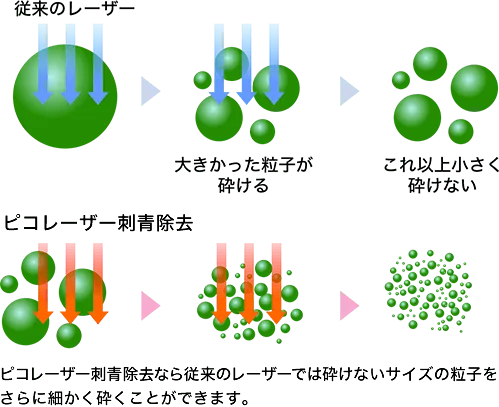埼玉でおすすめの安いタトゥー除去(刺青除去)SBCピコレーザーの特徴