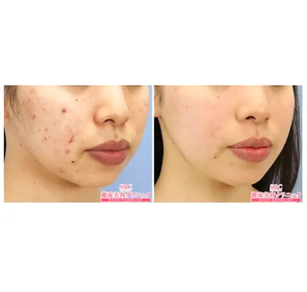 SBCのケミカルピーリングの症例