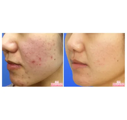 SBCのケミカルピーリングの症例