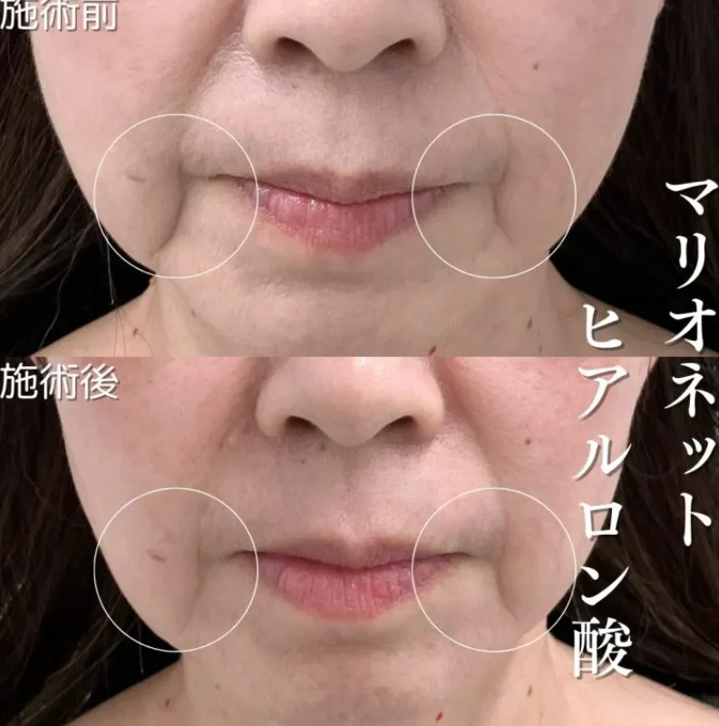 札幌でヒアルロン酸注射ができるおすすめのクリニック TCBの症例写真