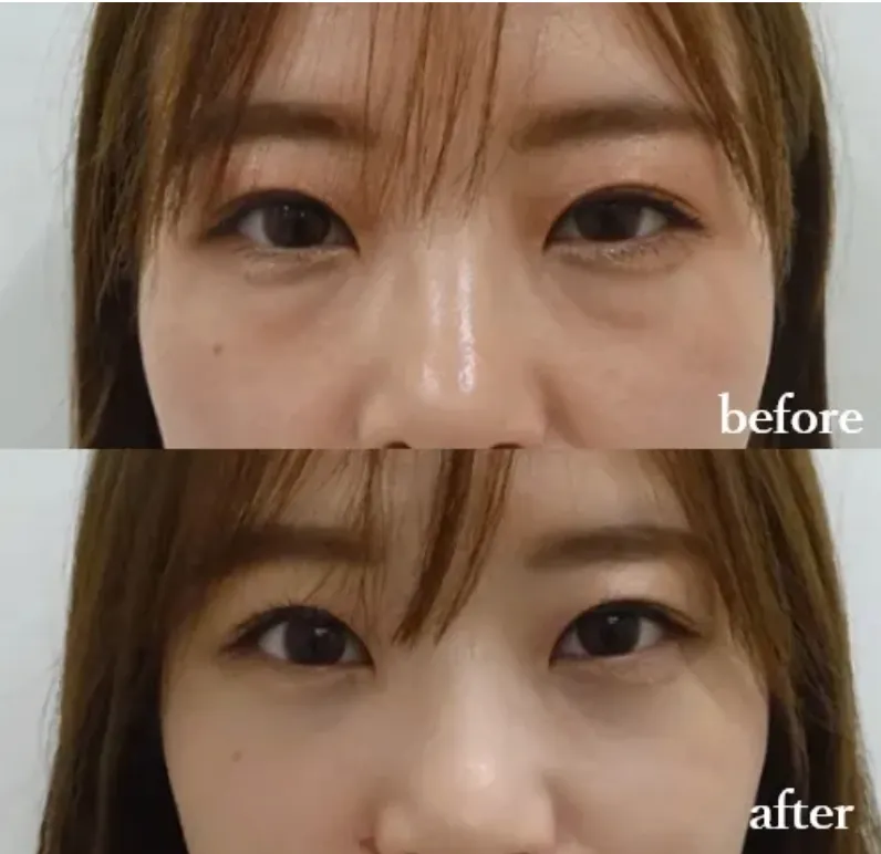 札幌でヒアルロン酸注射ができるおすすめのクリニック TCBの症例写真