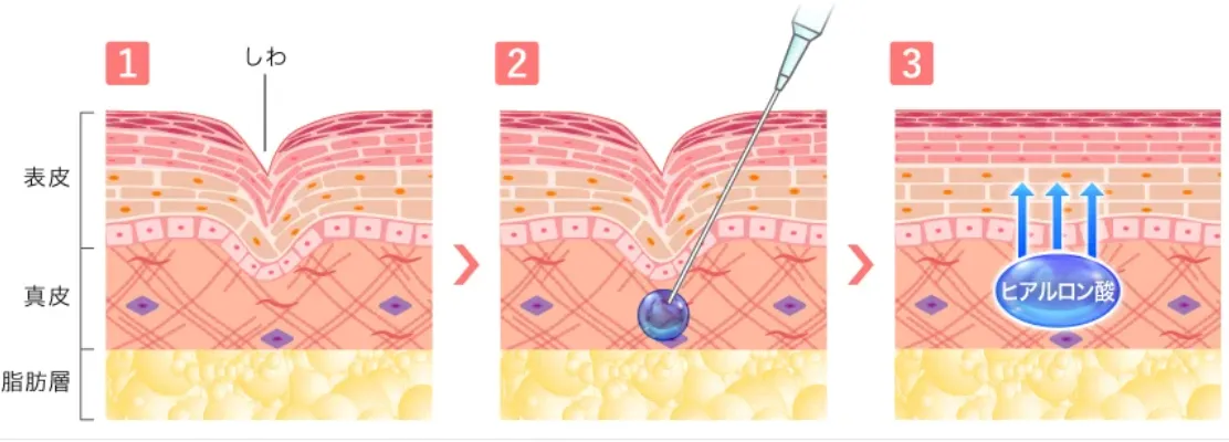 札幌でヒアルロン酸注射ができるおすすめのクリニック TCBの施術内容