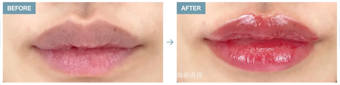 札幌でヒアルロン酸注射ができるおすすめのクリニック TCBの症例写真